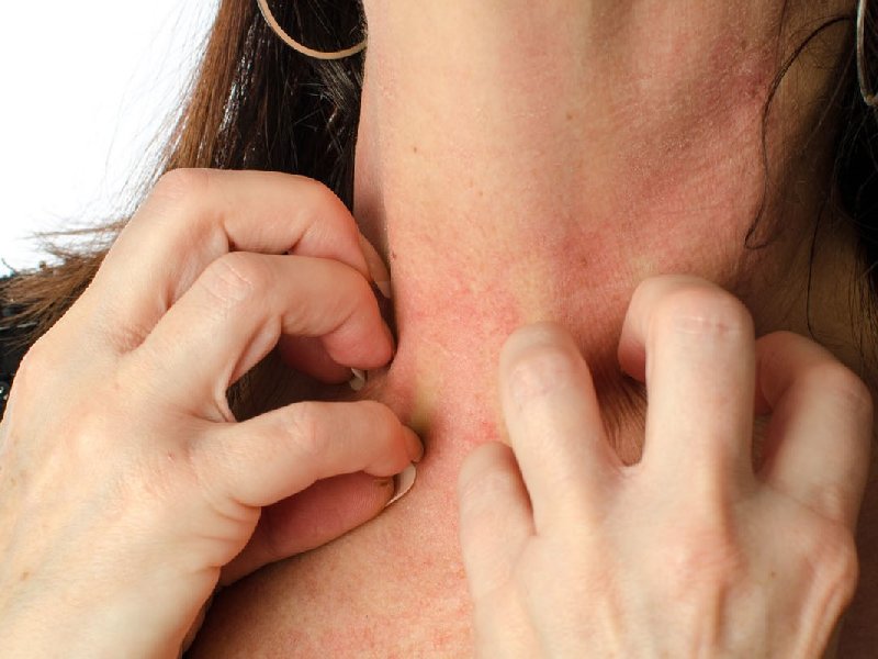 Atopowe zapalenie skóry, objawy i leczenie